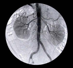 arteriography-1562063-640x600